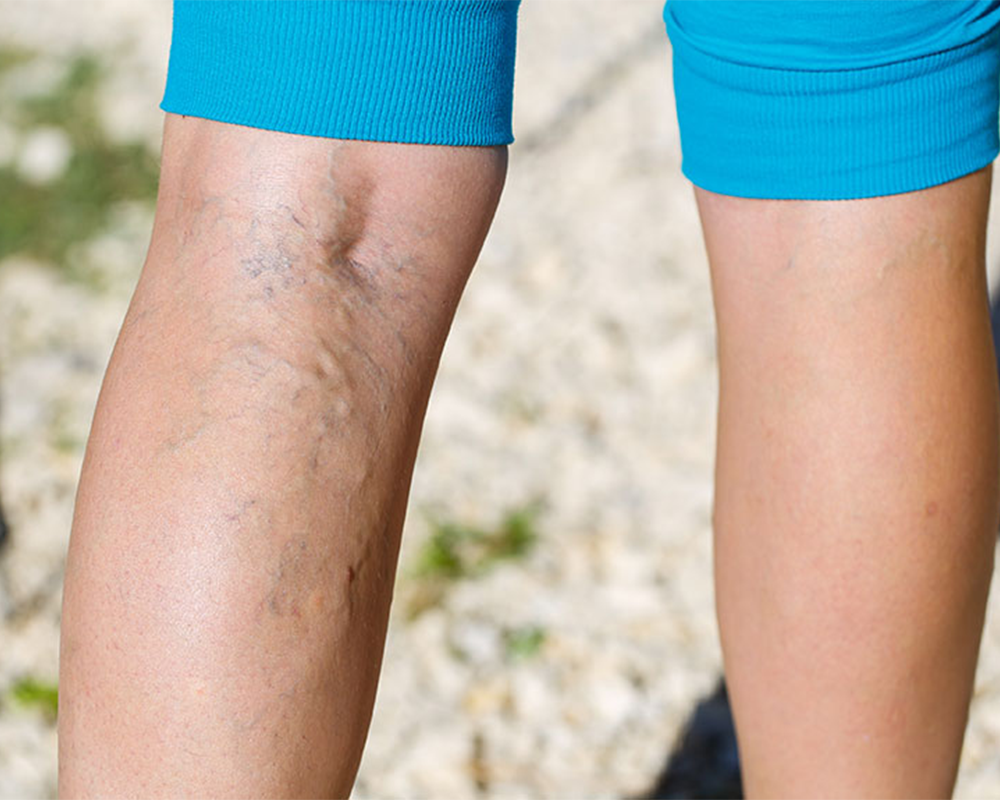 3 Different Types of Varicose Veins Vein Center in Walnut Creek